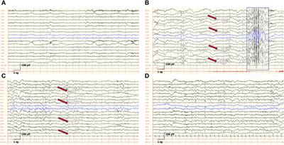 Developmental outcome of electroencephalographic findings in SYNGAP1 encephalopathy